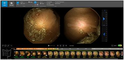 Artificial intelligence to improve polyp detection and screening time in colon capsule endoscopy